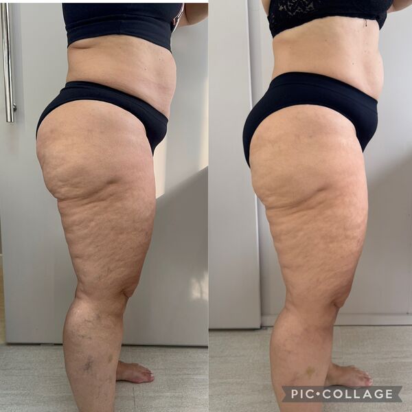 Resultado lipedema lateral direita - Dra. Anna Abreu